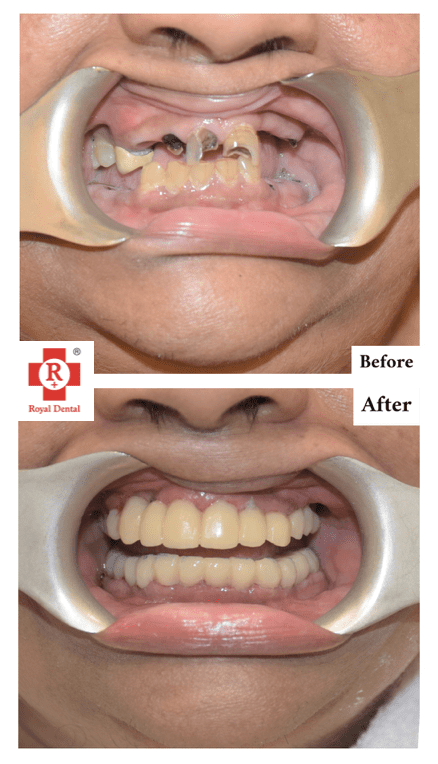Missing Teeth