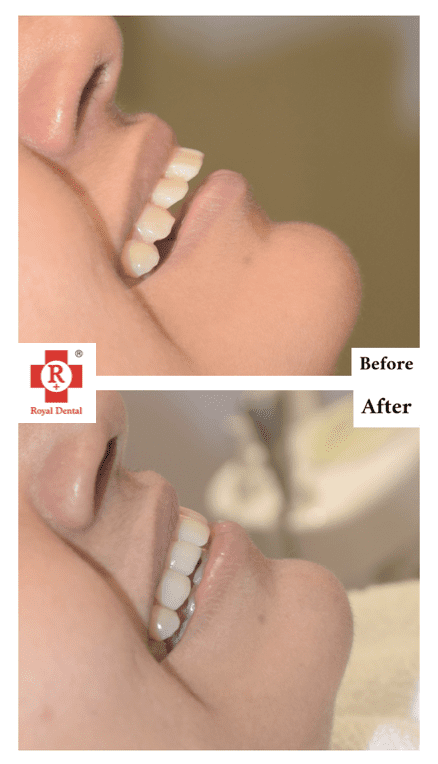 Protruded Teeth