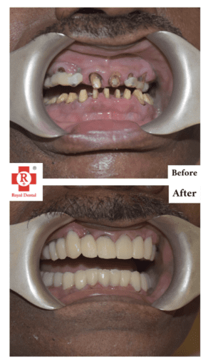 SAPTeeth Crown