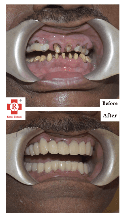 Dental Crown Breakage