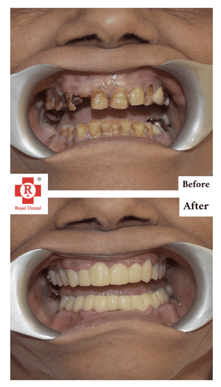 Dental Crowns in One Day