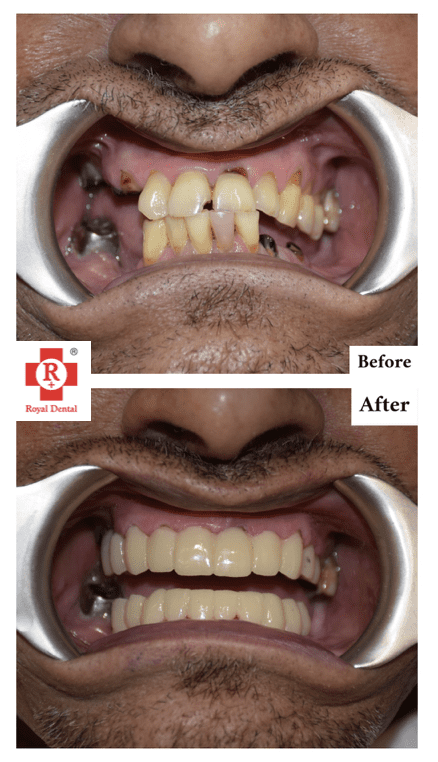 Full Mouth Makeover