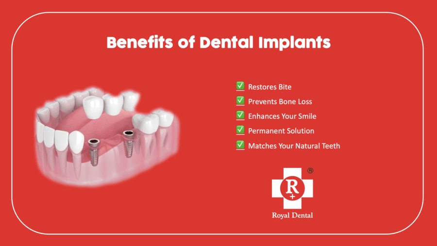 dental implants