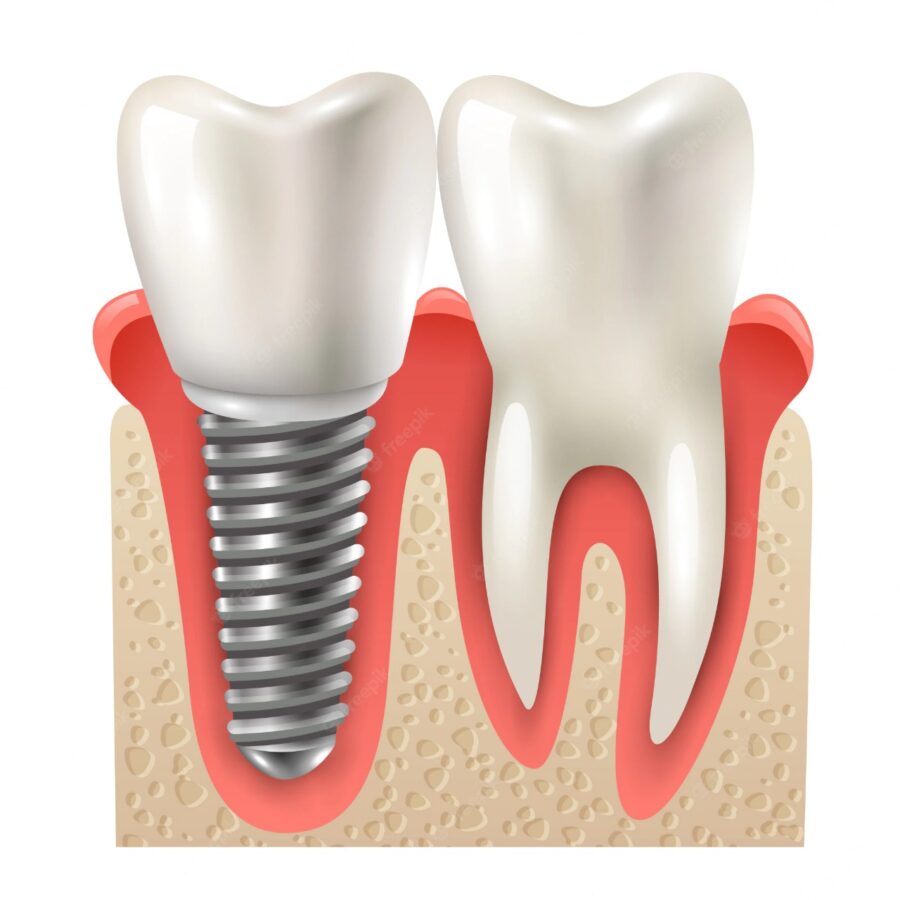 What-Does-My-Teeth-Look-Like-After-A-Dental-Implant