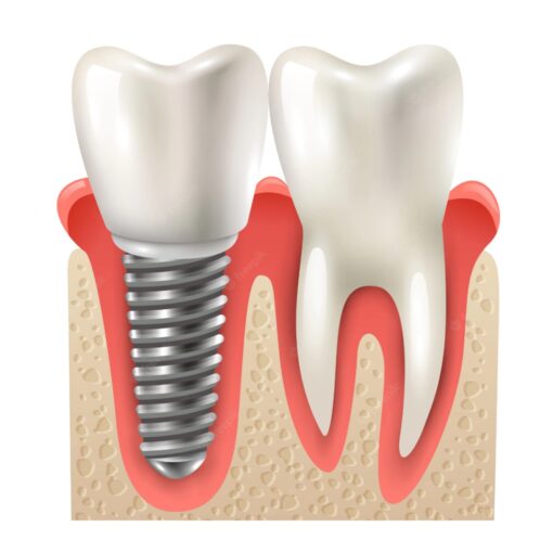 dental implant and tooth