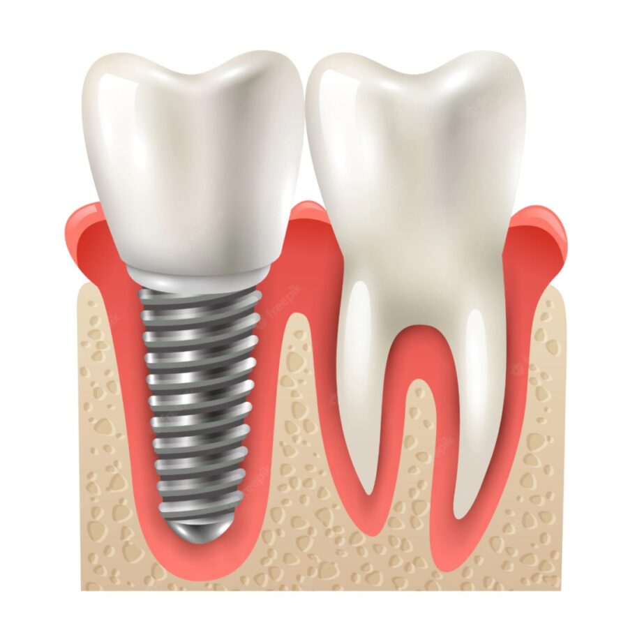 dental implant and tooth