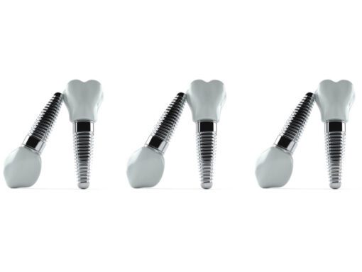Aluminium dental implants