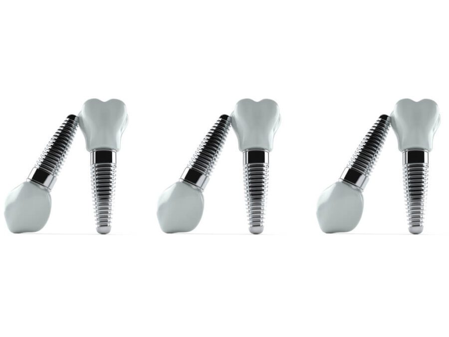 Aluminium dental implants