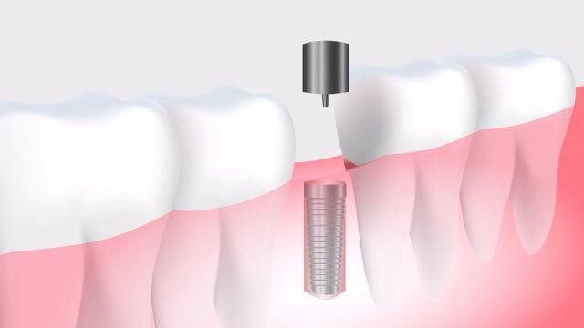 Loose Dental Implants