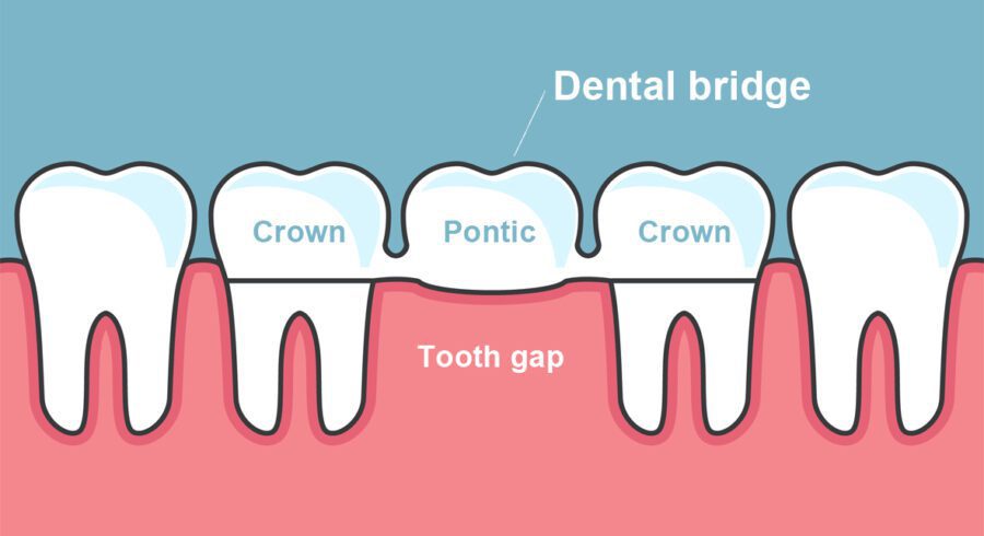 benefits of dental bridges