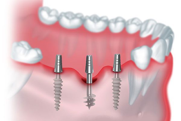 single stage immediate loading dental implant