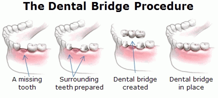dental bridge procedure