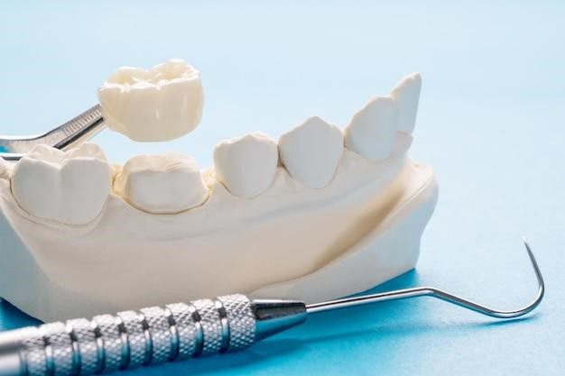 future of SAPTeeth single crown