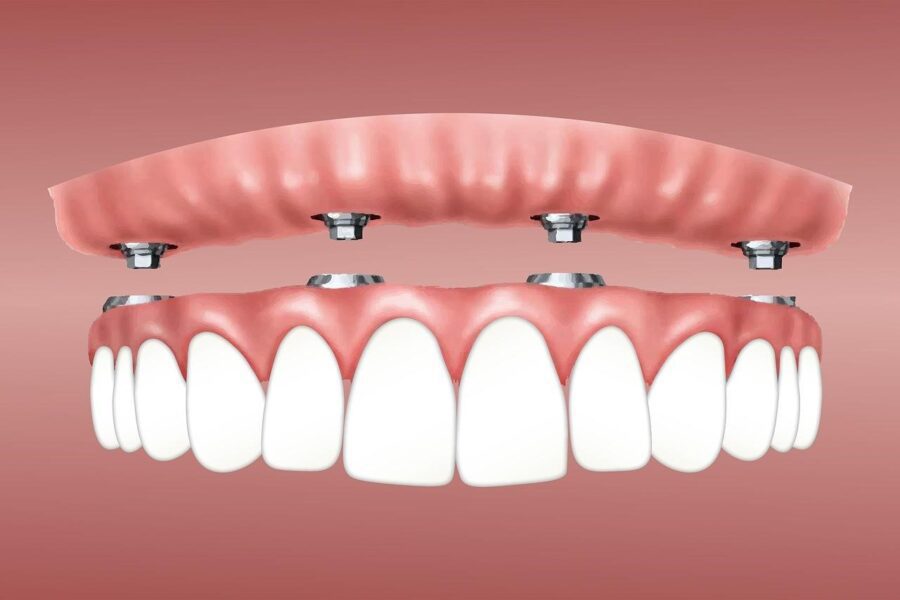 cost of implant denture