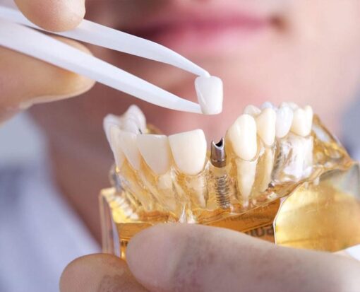Single crown over Implant