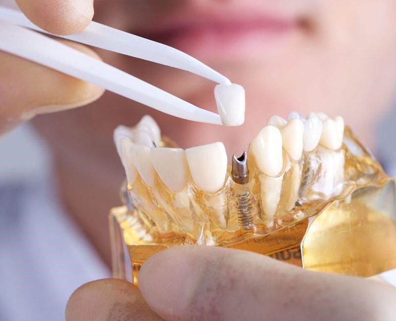 Single crown over Implant - dental implants vs veneers