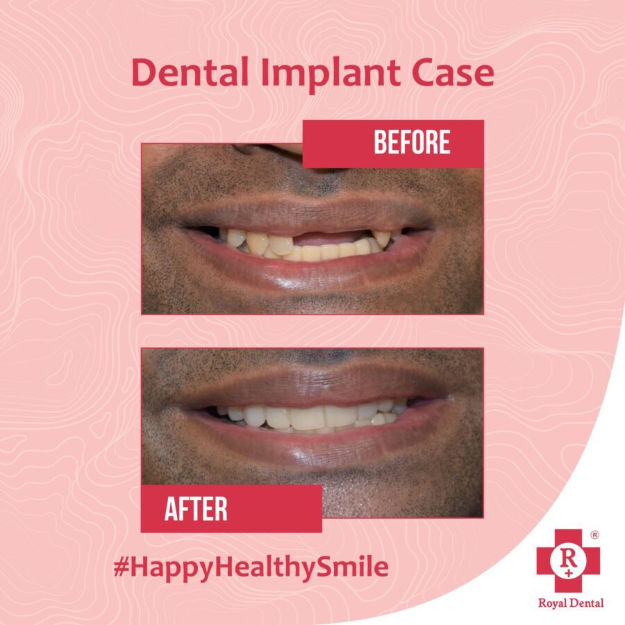 Before After Smile