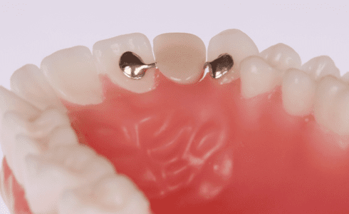 maryland bridge dental