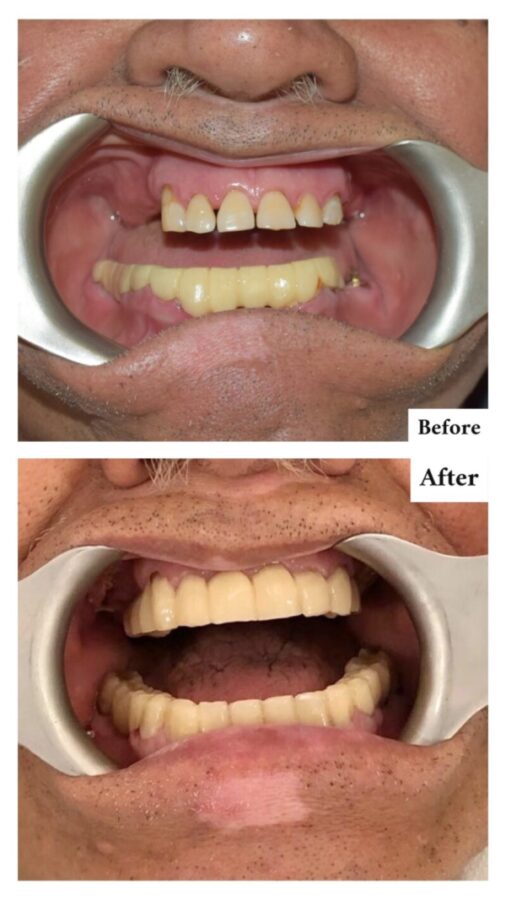 Zygomatic Dental Implant