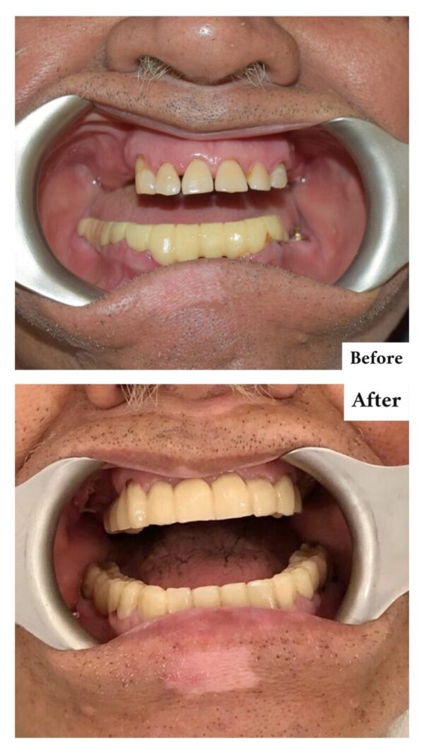 Zygomatic Dental Implant