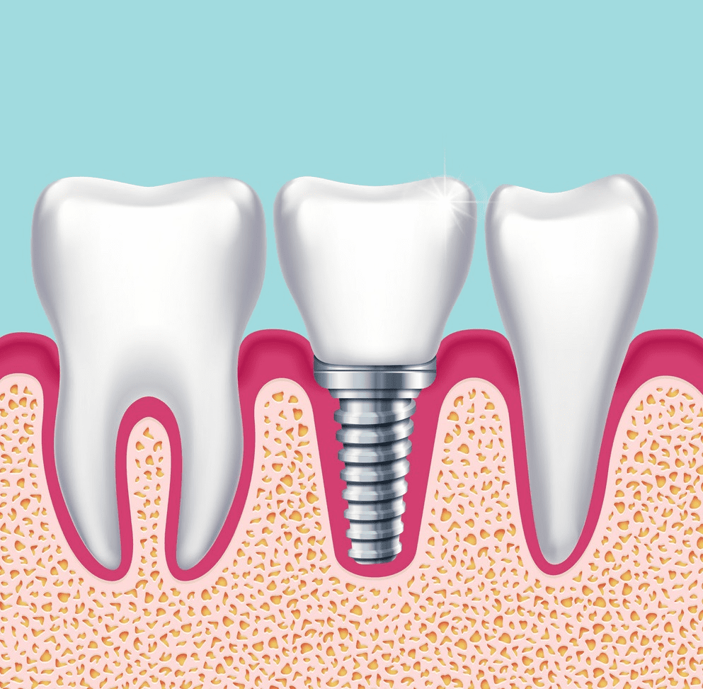 Teeth Implant Sparkle