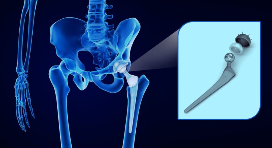 hip metal implants
