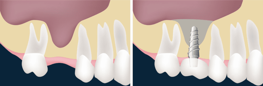 Extraction vs Dental Implant