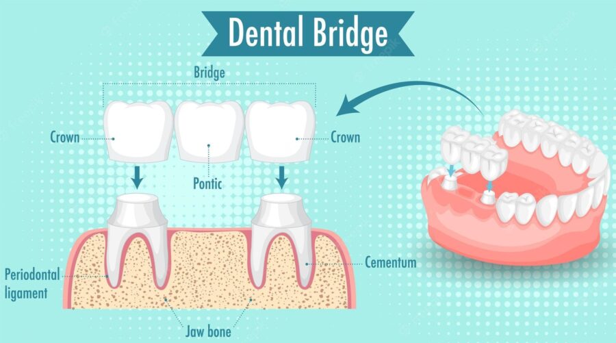 Are-Dental-Bridges-permanent?