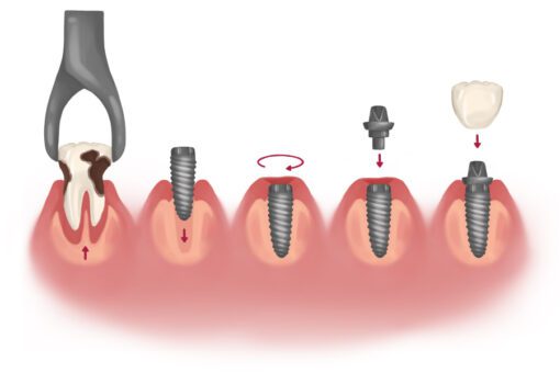 implant vs dental extraction