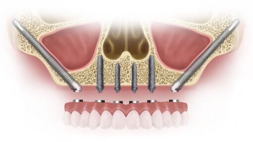 zygomatic implant