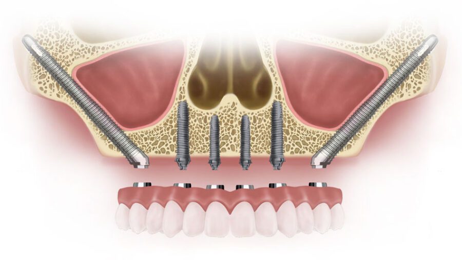 zygomatic-implant