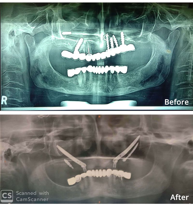 Zygomatic Implant with Fixed Teeth in One Day