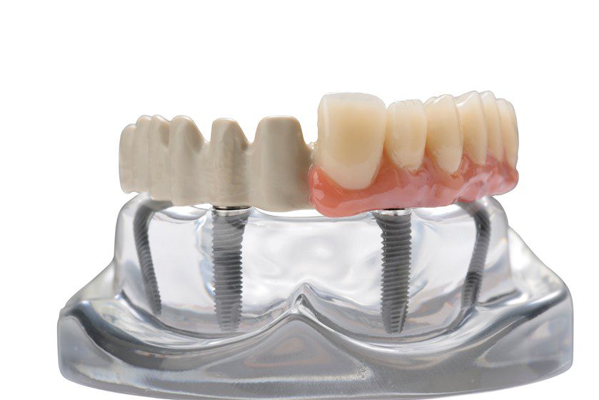 peek dental framework prosthodontics teeth
