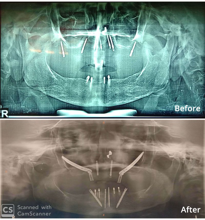 Before After Zygomatic Implant