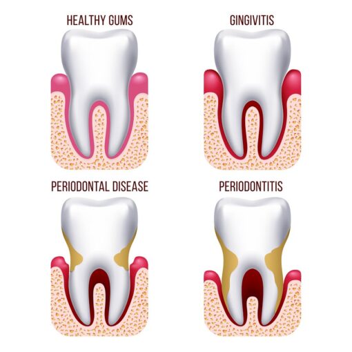 dental disease