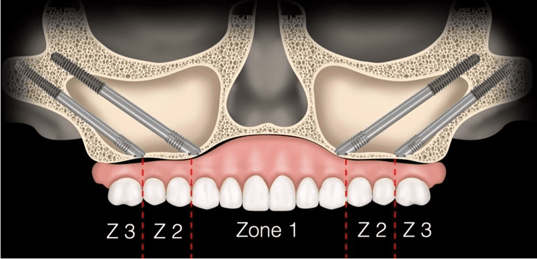Zygomatic Dental Implants for NRI