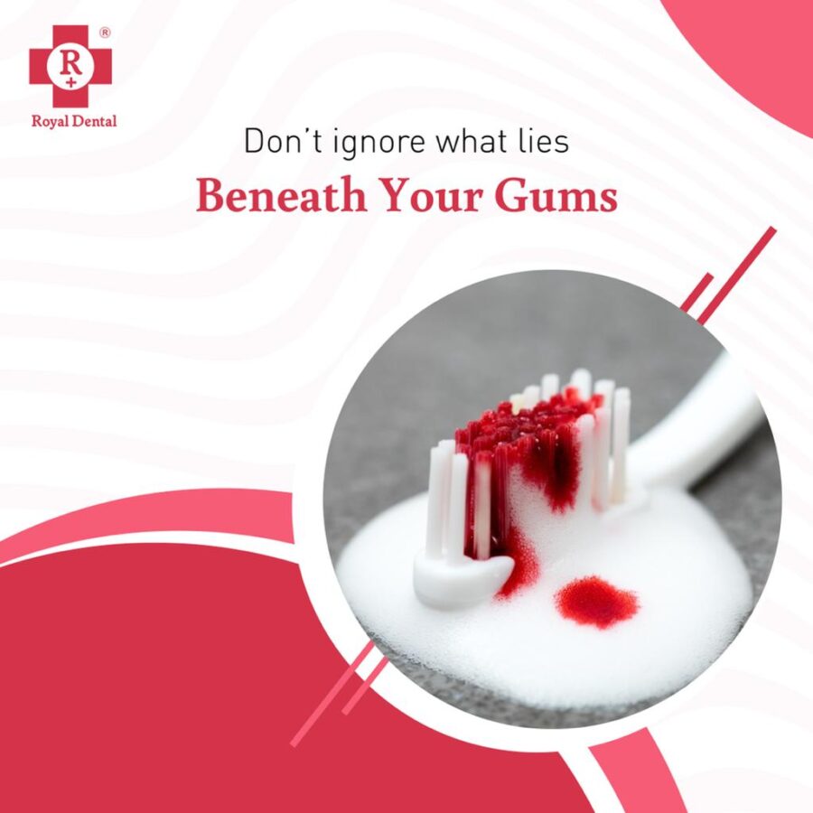 bleeding gums teeth