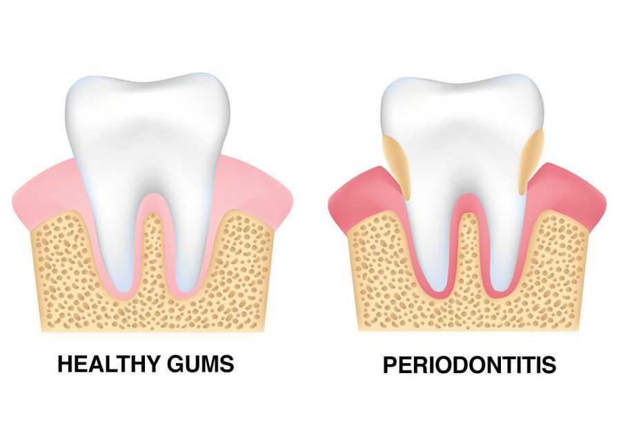 periodontal disease or periodontitis - Gum Recession Around Dental Crowns