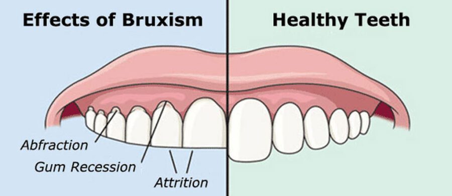 bruxism night grinding of teeth