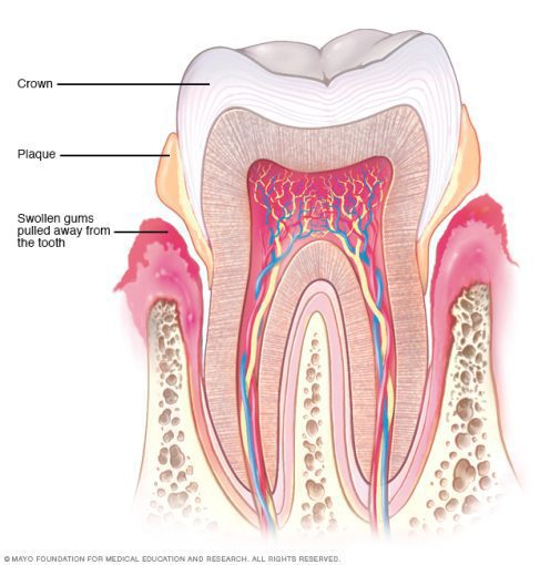 periodontal disease or periodontitis