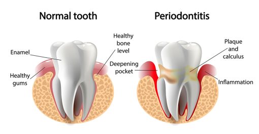 periodontal disease or periodontitis