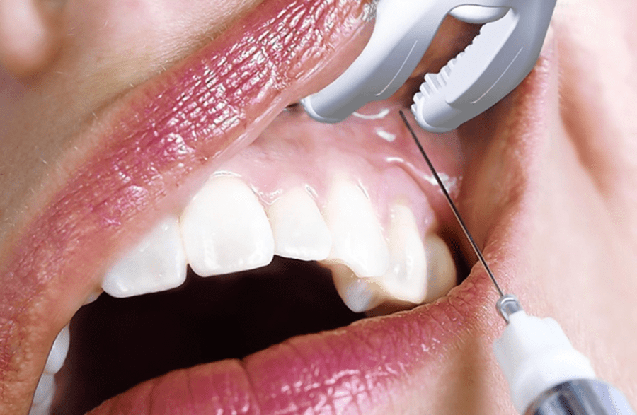 numb mouth