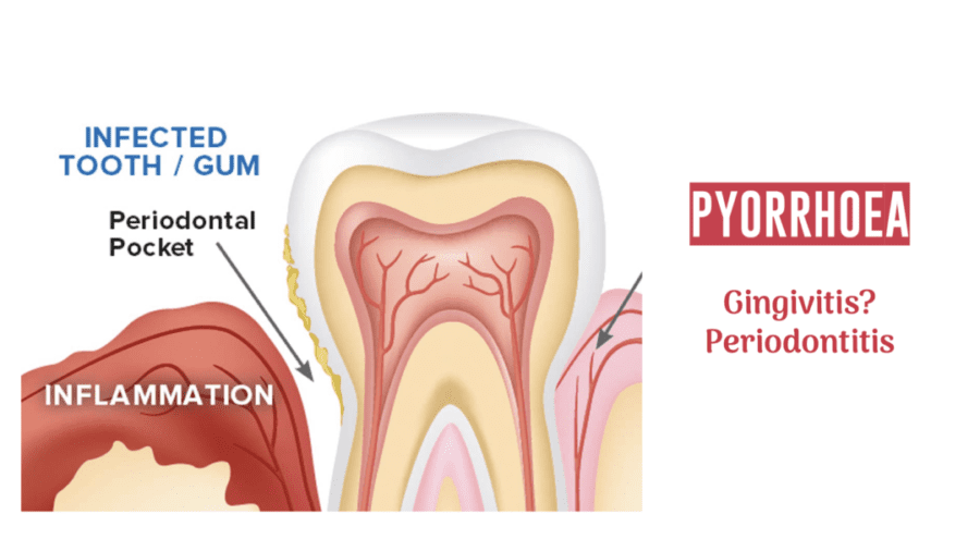 gingivitis and gum disease - Gum Recession Around Dental Crowns