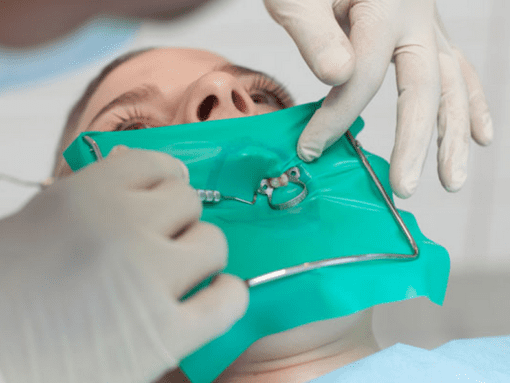 rubber dam root canal treatment