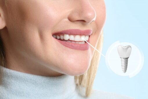 dental implant in bone