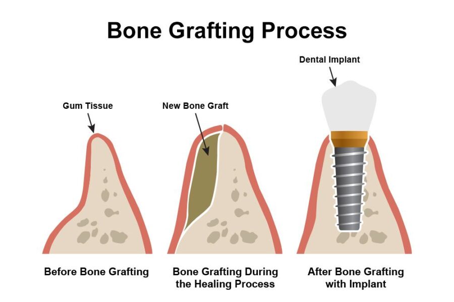 Bone_Grafting_Process