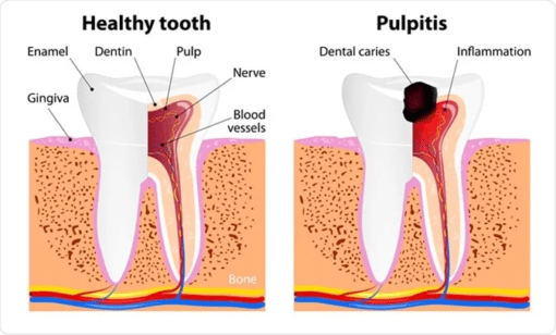dental hyperaemia bleeding