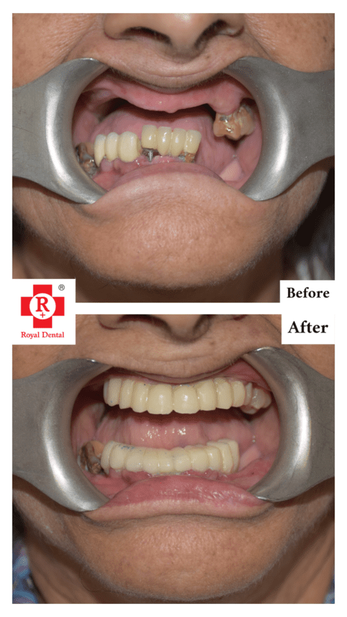 Full Mouth Rehabilitation