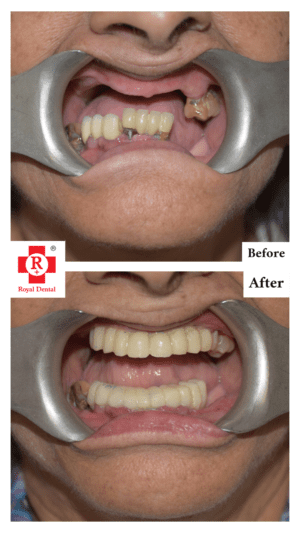 Full Mouth Rehabilitation