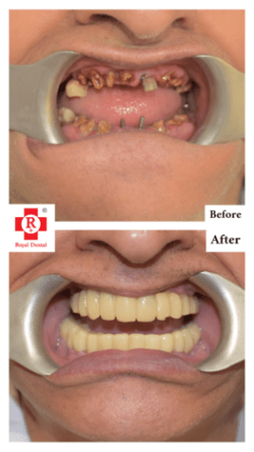 Full Mouth Tooth Implant
